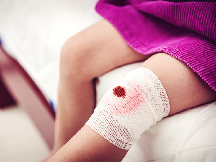 What to do when your child is bleeding